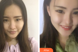 廣州現代醫(yī)院數字化整形美容中心謝大明整形價格表附鼻部手術案例展示