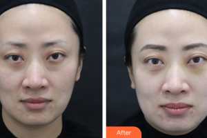 廣州求美醫(yī)學美容醫(yī)院周邵龍整形價格表附微創(chuàng)眼袋案例展示