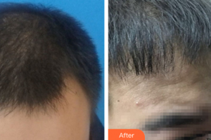 廣州中科美整形醫(yī)院姜衛(wèi)整形價格表附種植發(fā)際線案例展示