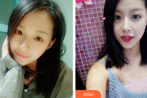 廣州畫美醫(yī)療美容醫(yī)院羅曼整形價格表附眼部整形案例展示