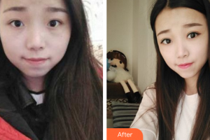 廣州求美醫(yī)學美容醫(yī)院張春林整形價格表附眼部手術案例展示