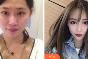 廣州求美醫(yī)學美容醫(yī)院黃紅云整形價格表附雙眼皮案例展示