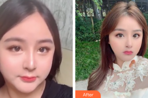 廣州天姿醫(yī)學美容門診部周祺整形價格表附面部吸脂案例展示