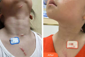 廣州膚康皮膚科醫(yī)院吳月志整形價格表附增生疤痕案例展示