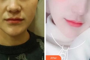 淮北天煌美容整形醫(yī)院吳長淮整形價(jià)格表附熱瑪吉案例展示