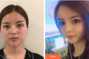 淮北天煌美容整形醫(yī)院張先俠整形價(jià)格表附埋線提升案例展示