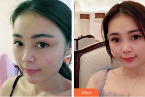 淮北時(shí)光整形美容醫(yī)院王峰整形價(jià)格表附激光祛疤案例展示