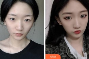 淮北市中醫(yī)院整形美容專科杜曉揚(yáng)整形價(jià)格表附切開雙眼皮案例展示