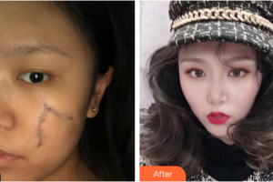 廣州軍美整形醫(yī)院何小建整形價格表附縫針疤痕案例展示