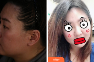 廣州海峽醫(yī)學整形美容醫(yī)院凌文娟整形價格表附埋線提升案例展示