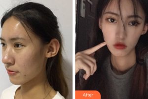 廣州美瑞兒醫(yī)療美容門診部樸壽根整形價格表附顴骨顴弓案例展示