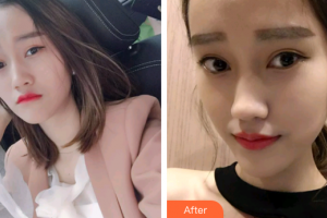 廣州愛康健口腔門診部李川整形價格表附時代天使矯正案例展示