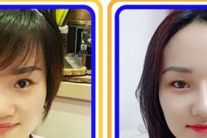 淮北美傾城醫(yī)療美容門診部李尚宇整形價(jià)格表附眼部整形案例展示