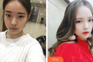 淮北博愛口腔醫(yī)院李龍整形價(jià)格表附切開雙眼皮案例展示