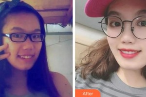 淮北博愛口腔醫(yī)院雷明光整形價(jià)格表附口腔矯正案例展示