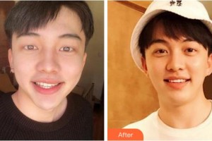 淮北博愛口腔醫(yī)院劉義整形價(jià)格表附美白貼片案例展示