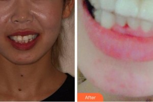 淮北愛美爾醫(yī)療美容門診部趙克儉整形價(jià)格表附牙齒隱形矯正案例展示