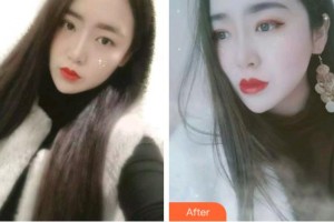 淮北口腔醫(yī)院胡貴飛整形價(jià)格表附金屬托槽矯正案例展示