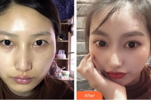 淮北愛爾眼科醫(yī)院高蓉整形價(jià)格表附眼部案例展示