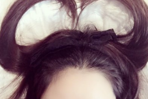 長沙宏朗眼科醫(yī)院王華整形價(jià)格表附切開雙眼皮案例展示