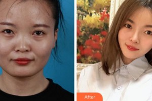 銅陵黃雷醫(yī)療美容診所劉育風(fēng)整形價(jià)格表附下頜角整形案例展示