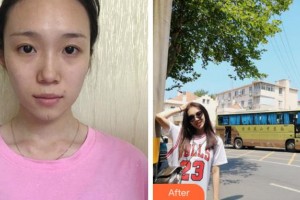 銅陵市人民醫(yī)院燒傷整形科錢尼文整形價(jià)格表附激光祛疤案例展示