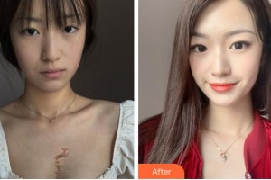 銅陵博愛醫(yī)院整形美容中心苗譯然整形價(jià)格表附微創(chuàng)疤痕修復(fù)案例展示