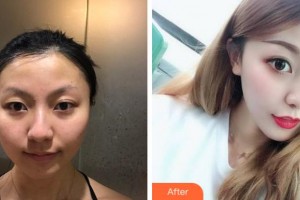 銅陵愛(ài)爾眼科醫(yī)院姜夏泉整形價(jià)格表附眼部整形案例展示