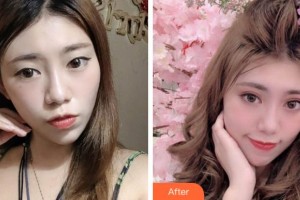 銅陵市婦幼保健院眼科張德明整形價(jià)格表附眼部綜合案例展示