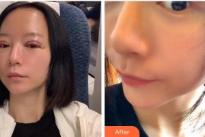 銅陵市立醫(yī)院眼科方劍峰整形價(jià)格表附切開(kāi)雙眼皮案例展示