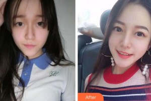 銅陵市立醫(yī)院眼科胡入虎整形價(jià)格表附切開(kāi)雙眼皮案例展示