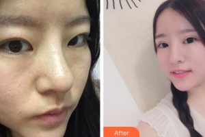 安慶亞星醫(yī)療美容門診部劉一正整形價(jià)格表附切開(kāi)雙眼皮案例展示