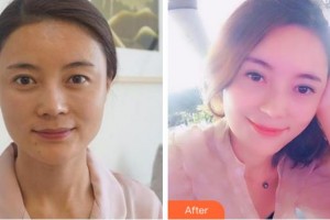 安慶市第一人民醫(yī)院整形外科程富順整形價(jià)格表附切開(kāi)雙眼皮案例展示