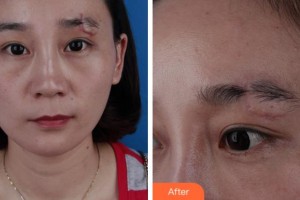 安慶亞星醫(yī)療美容門診部楊帆整形價(jià)格表附微創(chuàng)疤痕修復(fù)案例展示