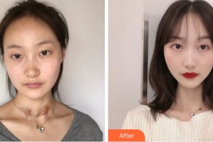 安慶維多利亞醫(yī)療美容門診部彭鵬整形價(jià)格表附祛疤案例展示