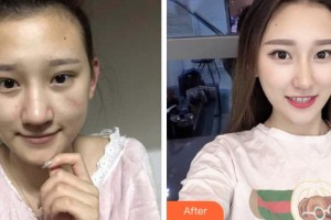 安慶維多利亞醫(yī)療美容門診部熊韜整形價(jià)格表附微創(chuàng)疤痕修復(fù)案例展示