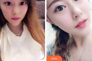 安慶渡江口腔醫(yī)院張良斌整形價(jià)格表附牙綜合案例展示