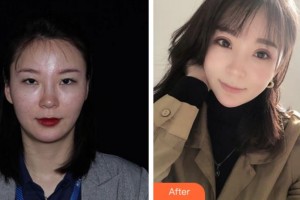 安慶施漢彬愛(ài)爾眼科醫(yī)院鄒召中整形價(jià)格表附眼部綜合案例展示