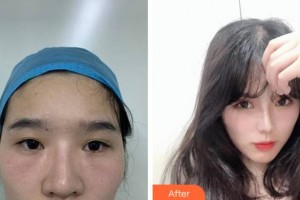 安慶市第二人民醫(yī)院眼科劉少勤整形價(jià)格表附雙眼皮案例展示