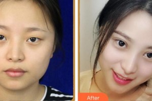 安慶市第二人民醫(yī)院眼科袁平整形價(jià)格表附眼部綜合案例展示