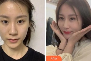 安慶市第二人民醫(yī)院眼科江兆源整形價(jià)格表附切開(kāi)雙眼皮案例展示