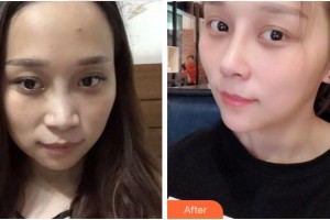 黃山心藝醫(yī)療美容門診部張斌斌整形價(jià)格表附肋軟骨隆鼻案例展示