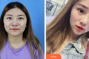 滁州伊爾美整形醫(yī)院孫洪香整形價(jià)格表附切開雙眼皮案例展示