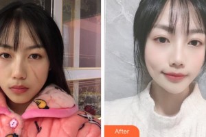 阜陽(yáng)楊鈞美容整形門診部楊鈞整形價(jià)格表附祛疤案例展示