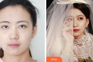 阜陽(yáng)市人民醫(yī)院整形美容外科馬杰整形價(jià)格表附熱瑪吉案例展示