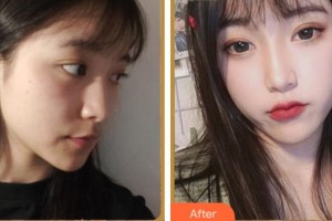 阜陽(yáng)市人民醫(yī)院整形美容外科裴麗麗整形價(jià)格表附埋線提升案例展示