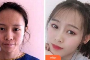 阜陽(yáng)楊鈞美容整形門診部楊利整形價(jià)格表附埋線提升案例展示