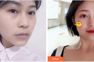 阜陽(yáng)七院愛爾眼科醫(yī)院尚力強(qiáng)整形價(jià)格表附面部抗衰案例展示