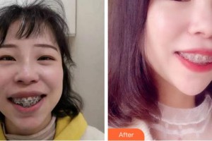 阜陽(yáng)愛齒口腔門診部李豐整形價(jià)格表附金屬托槽矯正案例展示