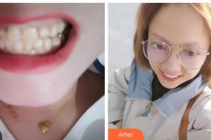 阜陽(yáng)愛齒口腔門診部陳立志整形價(jià)格表附全瓷牙案例展示